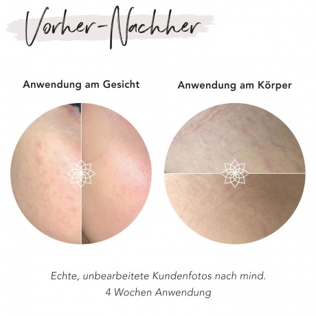 FACES OF FEY Microneedlingset Basic Hyaluron 0,75mm  Набор для микронидлинга Basic Hyaluron 0,75 мм