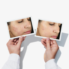 MURAD Invisiscar Resurfacing Treatment Процедура омоложения Invisiscar